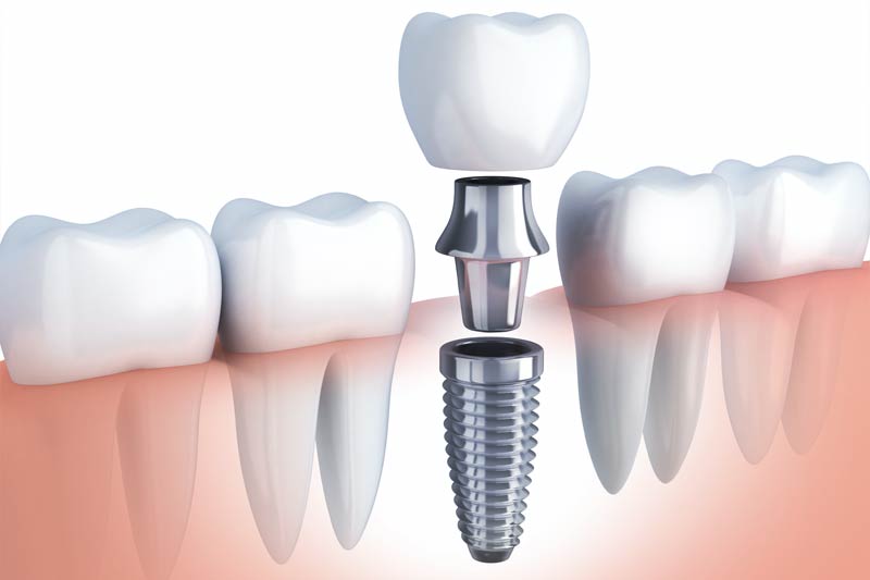 Dental Implants in Las Vegas